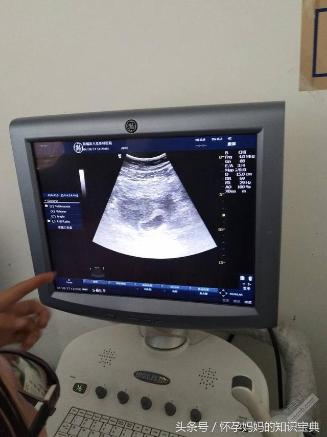 男宝宝b超分享 孕囊呈现椭圆形为男孩