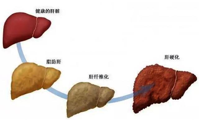 做好这6点,再也不用担心脂肪肝变成肝癌!