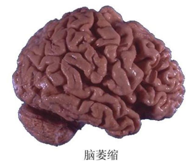 脑萎缩等于老年痴呆吗?坚持这样锻炼大脑,老了也不怕