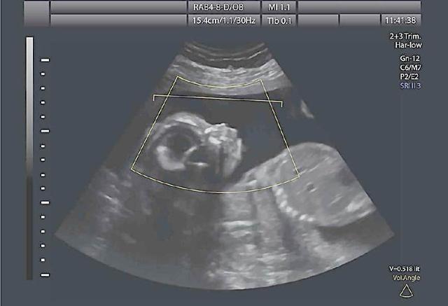 即在孕4月后可以通过b超来看胎儿性别,三维b超看胎儿性