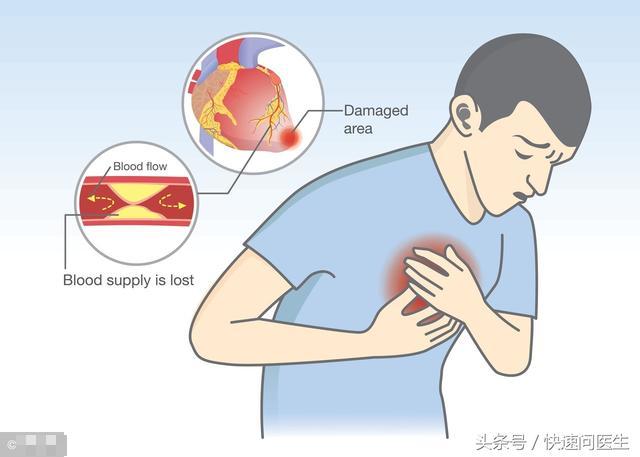 急性心肌梗死发出的信号,学会4招可自我急救!9个小妙招教你预防