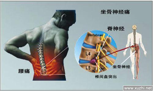 腰部疼痛: 大多数腰椎间盘突出的患者都有腰痛