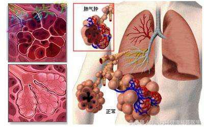 肺气肿是怎么回事,肺气肿有什么症状,肺气肿能治愈吗?
