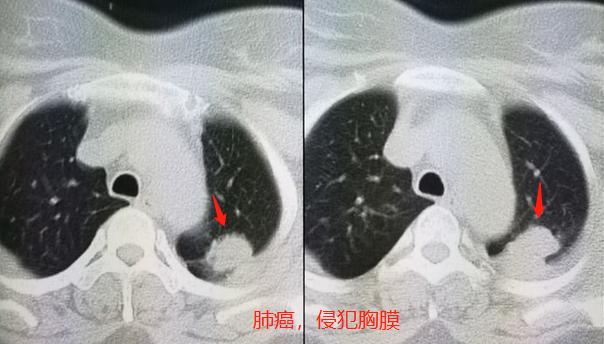 肺癌4年,她治愈了,但他却…豪大夫讲肺结节(五)