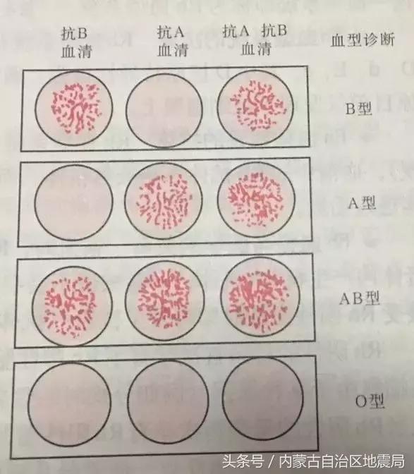 正文   我们医学部的学生在生理学实验课上都会做这个鉴别血型的凝集