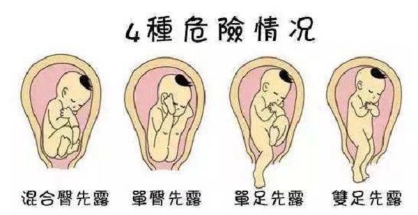 B超单上出现两个字，你要做剖腹产准备了，八周内矫正过来还有戏