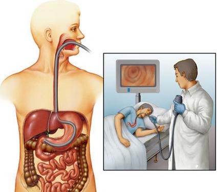 无痛胃镜和普通胃镜,哪一个更好?看胃肠医生的选择就