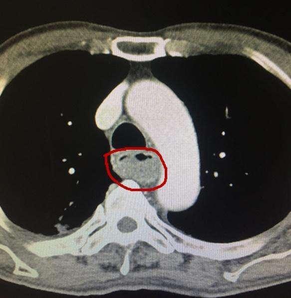 胸段食管癌外侵与转移的螺旋ct表现特点