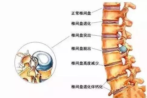 腰间盘突出自我康复疗法,简单不花钱~有效!