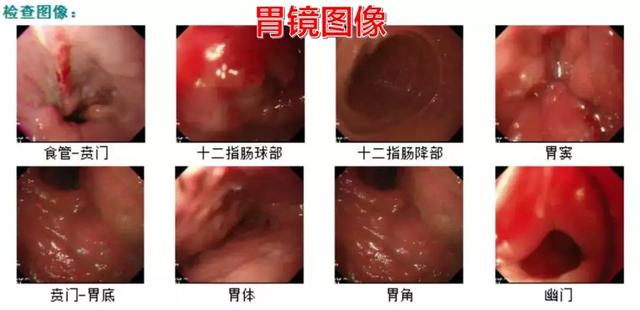 [养生管家]多学科讨论：一例HER2阳性Ⅳ期胃癌患者的治疗