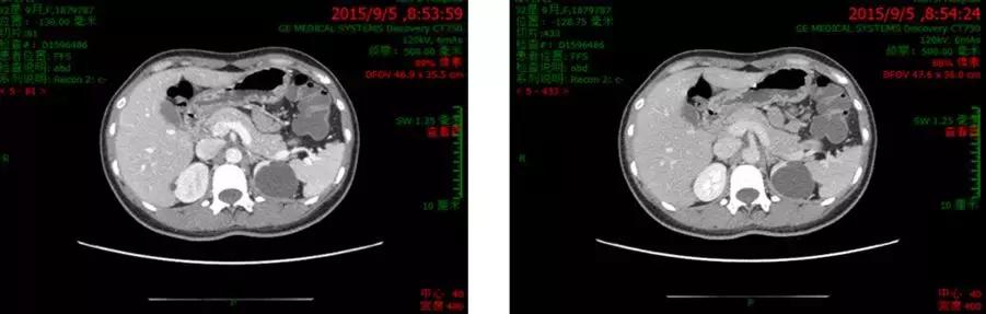 [养生管家]多学科讨论：一例HER2阳性Ⅳ期胃癌患者的治疗