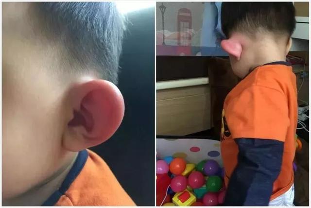被蚊子咬后第一件事做什么？大部分人都搞错了
