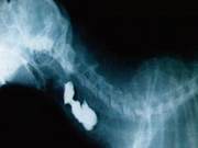 Cat Esophageal Diverticulum(4) Esophageal Pouches
