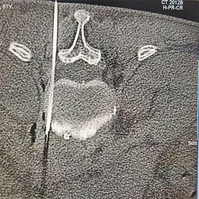 疼痛|滨医烟台附院疼痛科成功为恶性肿瘤患者实施腹腔神经丛毁损术