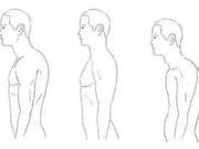The Root Causes of Rounded Shoulders and Hunched Back (Part 2)