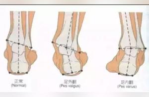 Ankle Sprain: How to Treat and Recover?