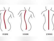 Pilates – How to Correct Spinal Curvature