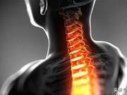 5 Types of Exercises That Are the Worst for You If You Have a Herniated Disc