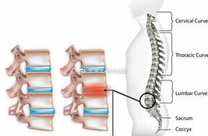 Sports and Rehabilitation: How to Delay Spinal Disc Degeneration