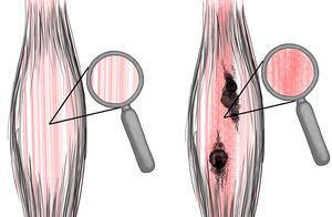After Achilles Tendon Rupture and Adhesion, How to Recover, What Details?