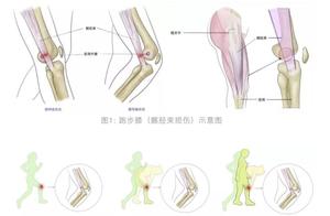 How to Treat and Prevent 'Runner's Knee'