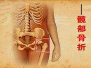 Post-Hip Replacement Rehabilitation: How to Divide the Stages?