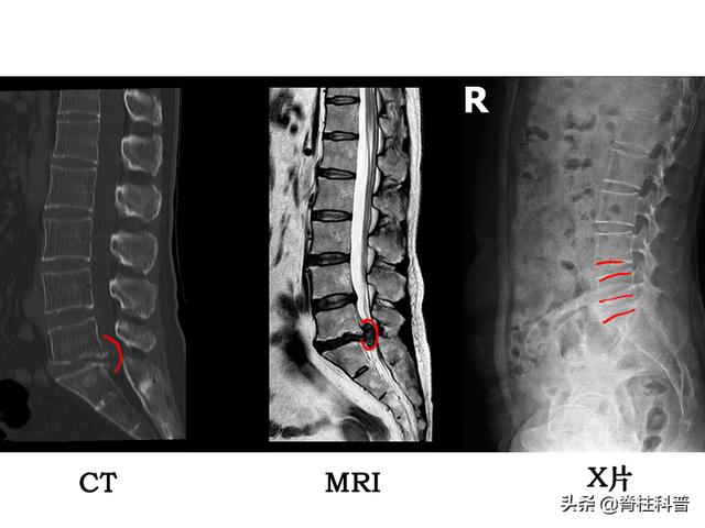 影像学|X光看不清，CT辐射大，腰突只想做最贵的核磁共振，为什么不行？