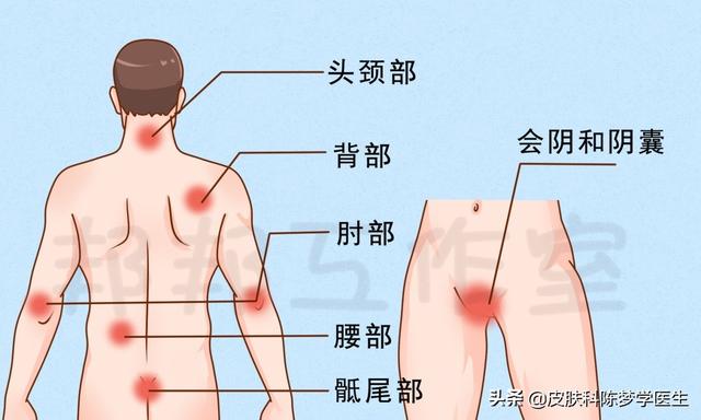 晚上睡不着，皮肤痒痒痒，神经性皮炎该怎么办？