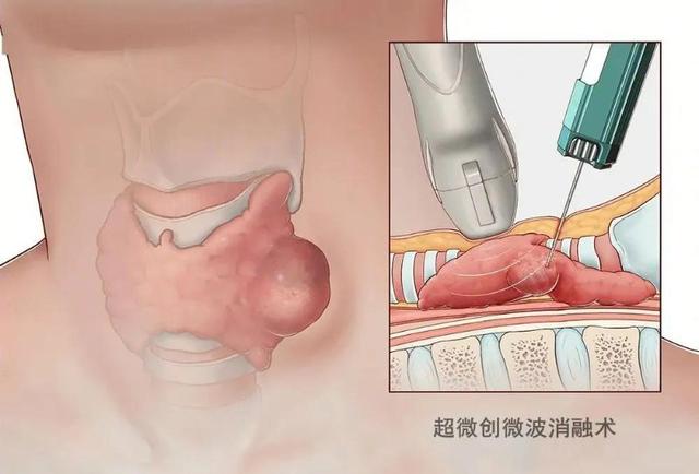 做了甲状腺结节微创消融术后会复发吗？术后有哪些注意事项？