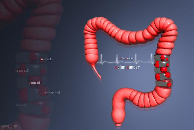 「年轻女性查出肠癌」大肠癌不可怕，可怕的是引起的并发症