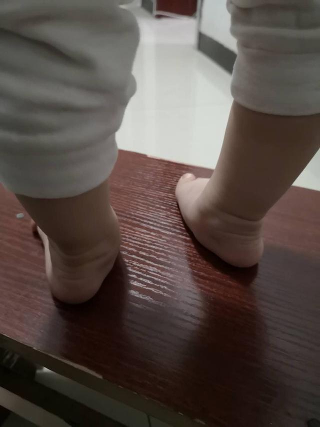 超级宝妈|足外翻需要怎样治疗预防？