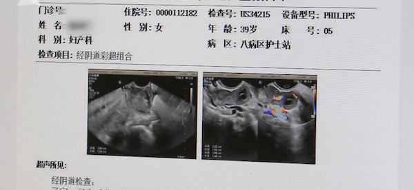 罕见！女子宫内宫外同时受孕 &quot;鬼门关&quot;外走一遭