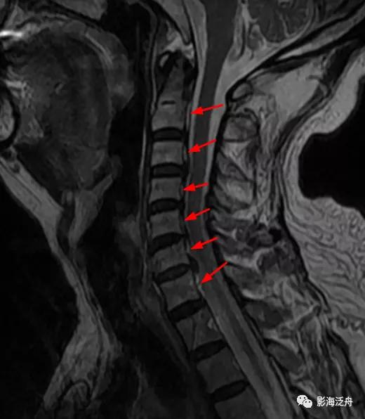 典型病例——颈椎后纵韧带钙化（MR）