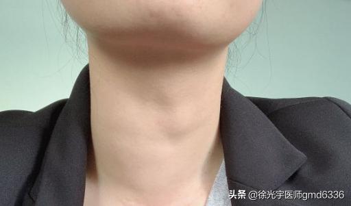 专家教你通过这些“蛛丝马迹”揪出甲状腺癌