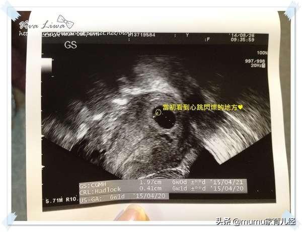 超级宝妈|孕六周第一次B超：照到心跳了！一闪一闪亮晶晶