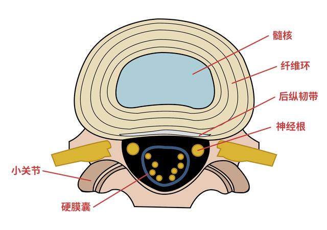 腰椎间盘出现钙化，严不严重？能不能治好?