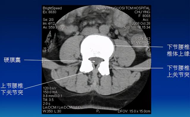腰椎间盘CT诊断：椎间盘膨出、突出、椎管狭窄及退行性病变