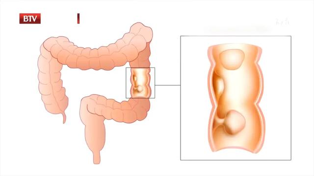 肠道|这类特殊肠癌，易遗传、危害大！平时留意一个习惯，帮助筛查