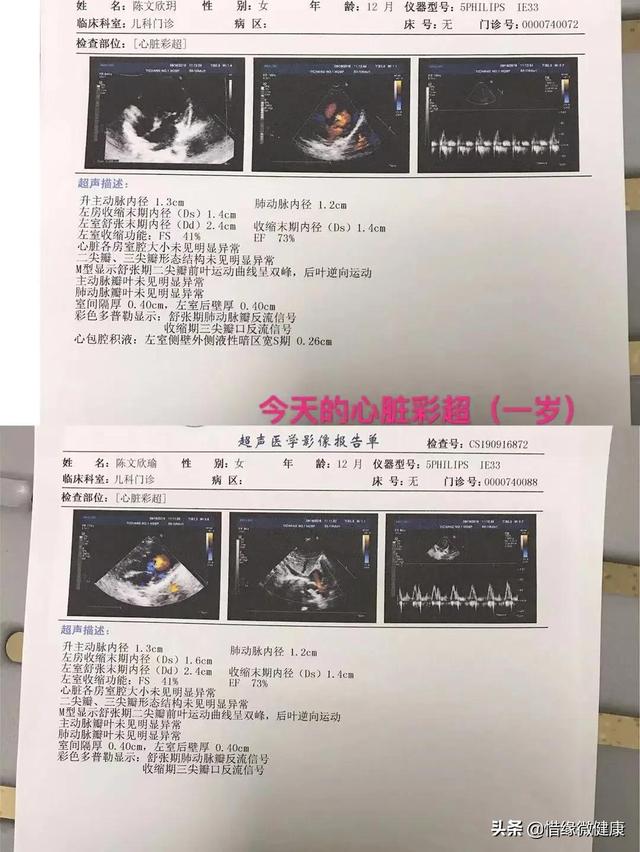 双胞胎先天心脏闭合不全，是如何6个月再造心脏