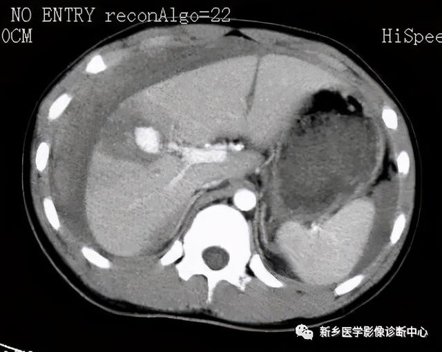 夜间值班腹部疼痛原因影像表现，值得收藏