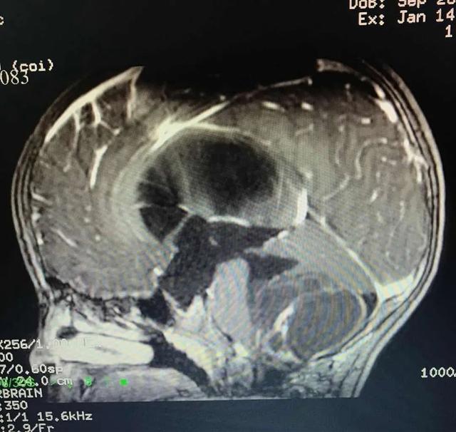 [南方都市报]5岁男童脑袋里长个鸡蛋大的肿瘤！孩子出现行走不稳症状要警惕