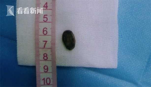 #你的育儿经#体质不好？5岁女童呼吸不畅常咳嗽 竟是西瓜籽卡气管近两年