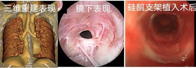 患者|想要自由呼吸？这个团队来帮您