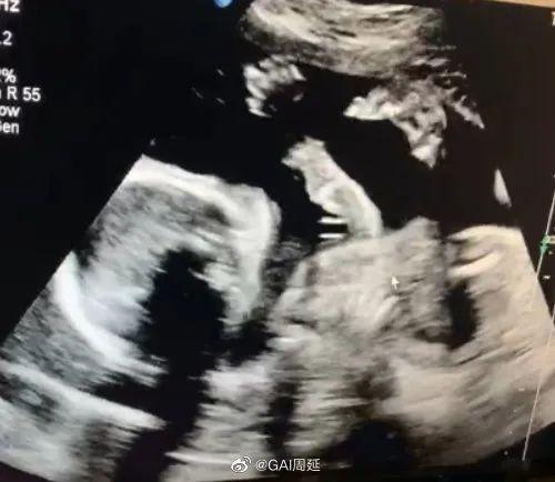 “小小盖”出生！GAI官宣当爸喜讯|资讯早知道