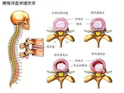 椎间盘|了解一下什么是 腰椎间盘