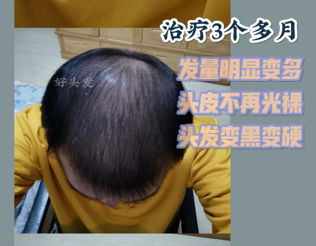 非那雄胺的真实有效率是多少（五位发友改善一年，终于告别稀疏）