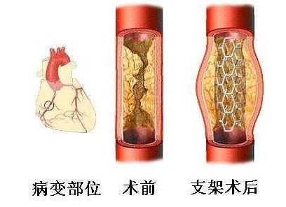 降价了！东莞7家医院患者已用上几百元的冠脉支架