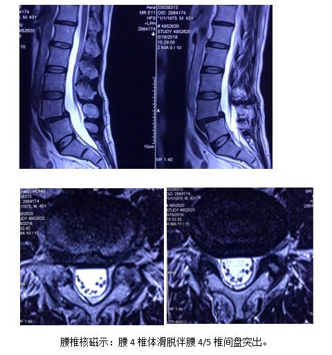 病例：腰椎斜前方入路椎间融合术+后路经皮内固定术