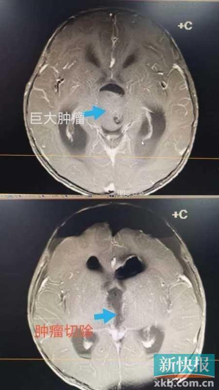 超级宝妈|两岁女童得脑肿瘤，家长要警惕孩子莫名手抖昏睡头痛高热惊厥等症状