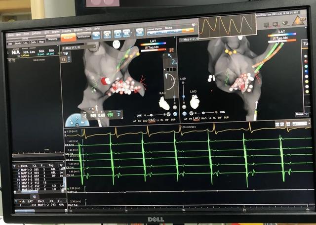房扑|莞医新动能 | 虎门医院实施首例三维标测下房扑射频消融术